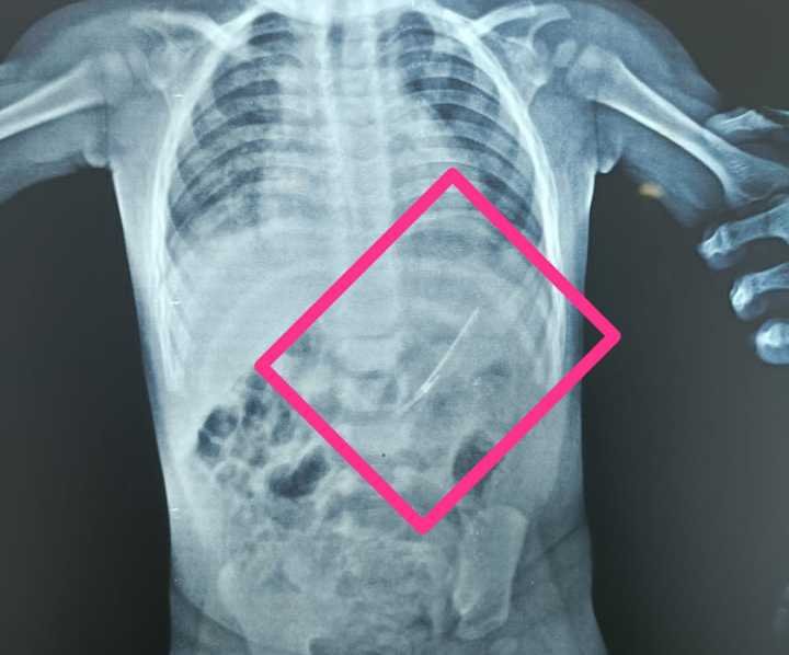 Meppadi successfully pulled out the open pin that had gone into the baby's stomach image