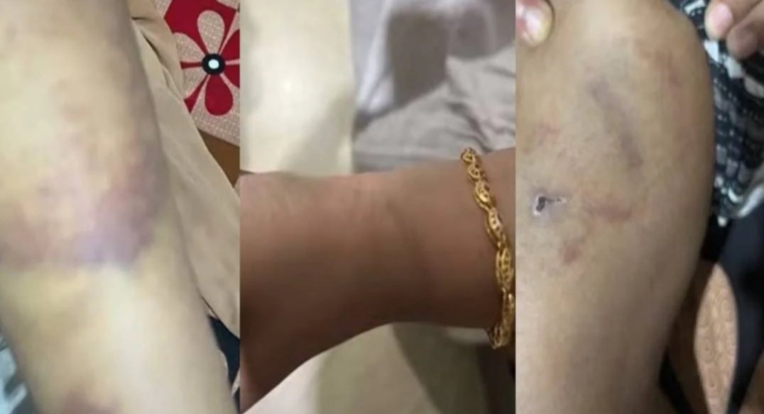 Malappuram, Newlywed bride brutalized by husband, harassed by saying she is not beautiful; Hearing impaired