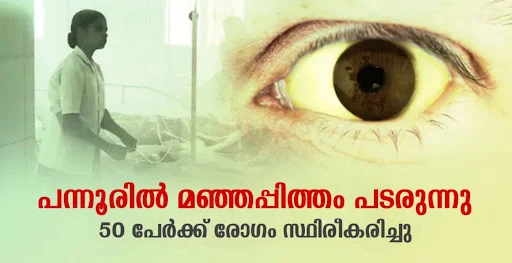 jaundice-is-spreading-in-elettil-pannur-50-people-have-been-diagnosed-with-the-disease